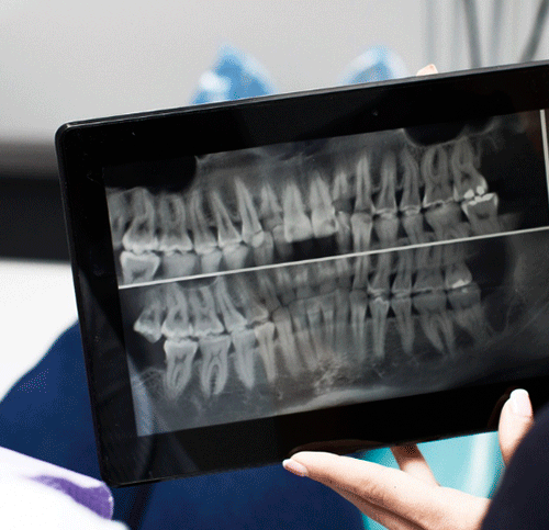 A detailed radiograph capturing the nuances of a root canal procedure, providing a comprehensive view of dental health