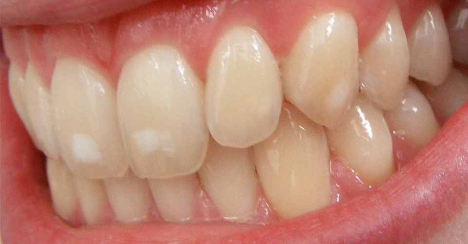 manchas blancas en los dientes