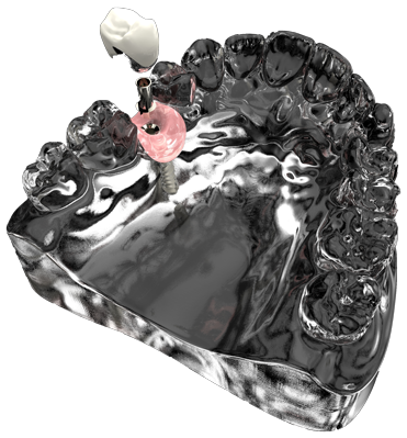 tijuana dental implants