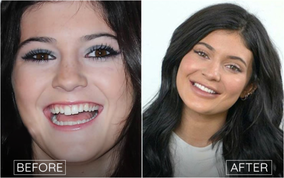 Celebrities Cosmetic Dentistry | Teeth Before and After