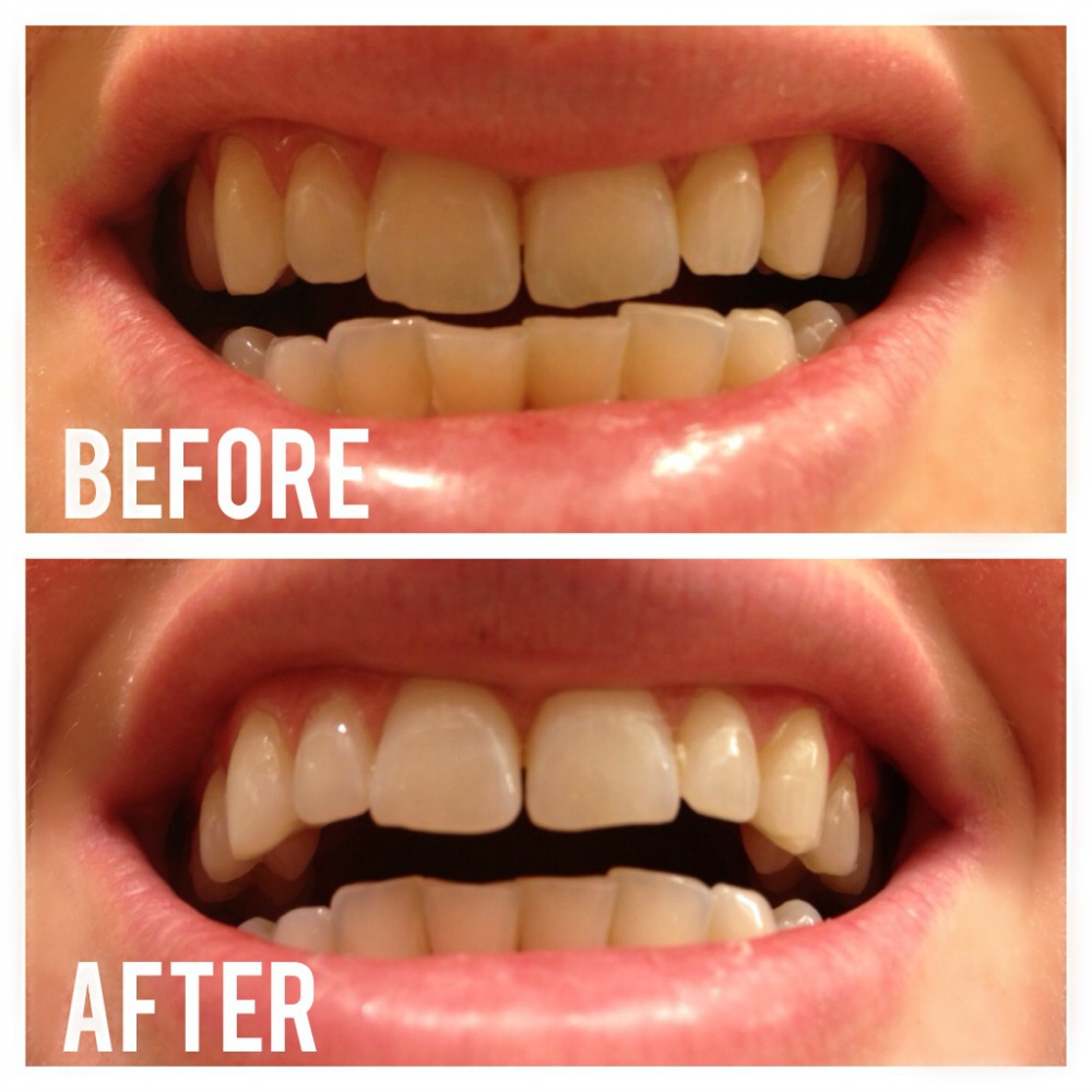 Does Activated Charcoal Teeth Whitening Works? You Need to ...