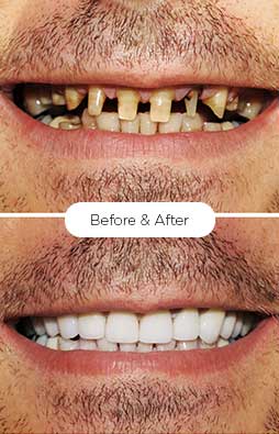 Dental Implants from Celeb Jaws Health