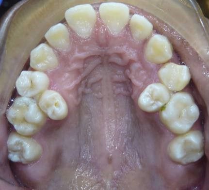 xray freddie mercury teeth
