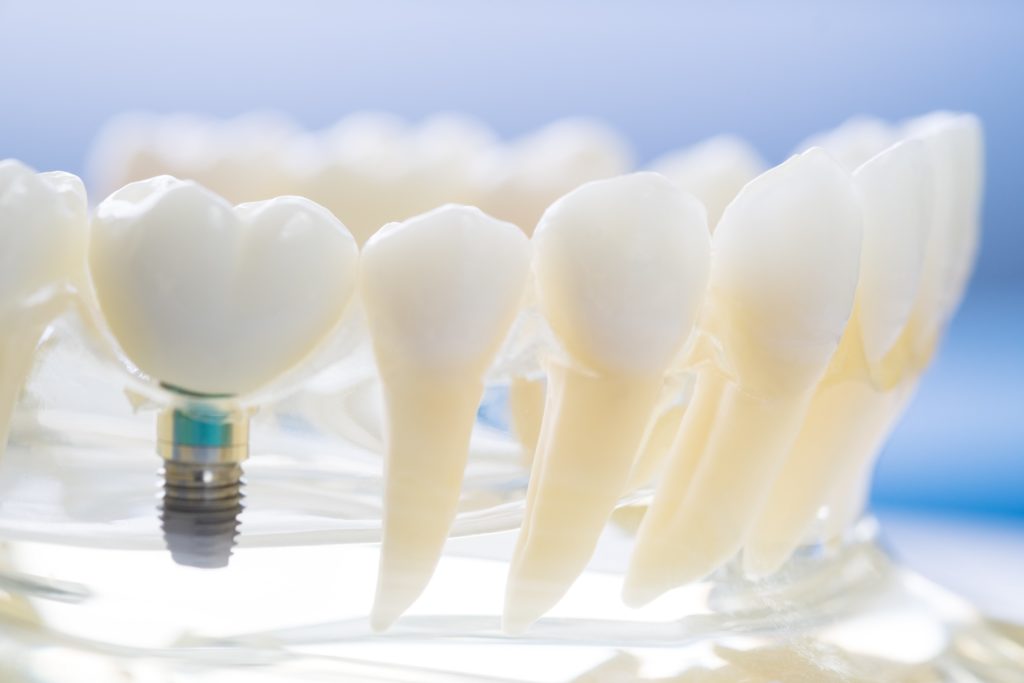 What Are Your Options to Replace Missing Teeth? 3