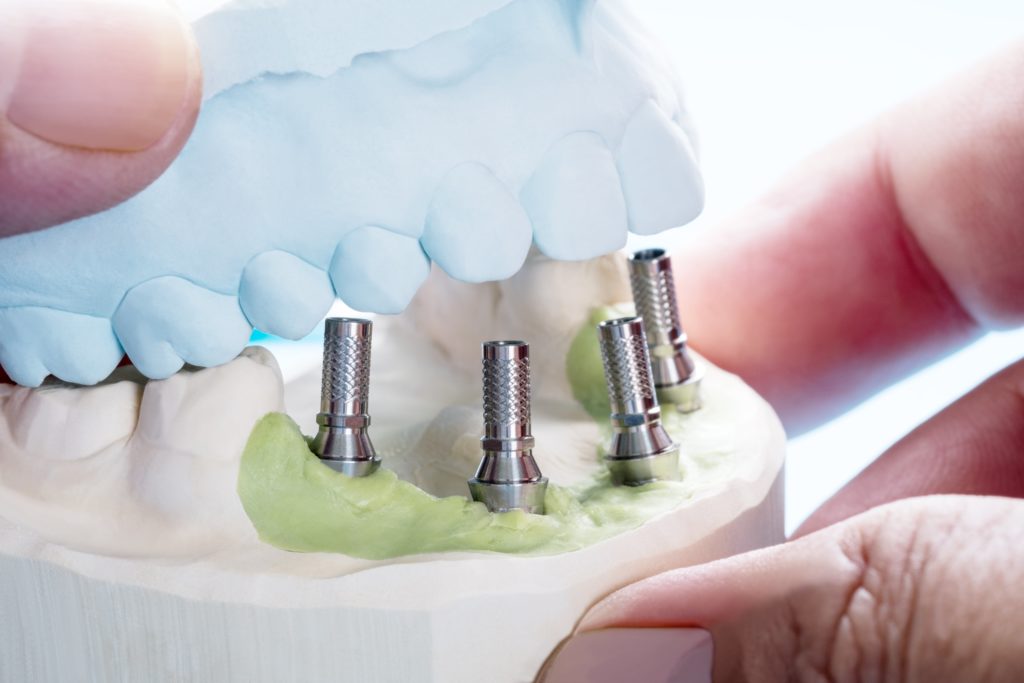 What Are Your Options to Replace Missing Teeth? 1