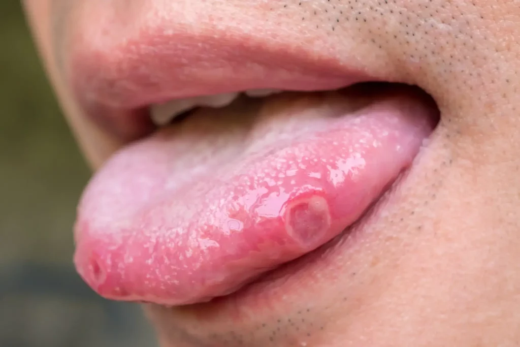 mouth ulcers pain injury in toungue