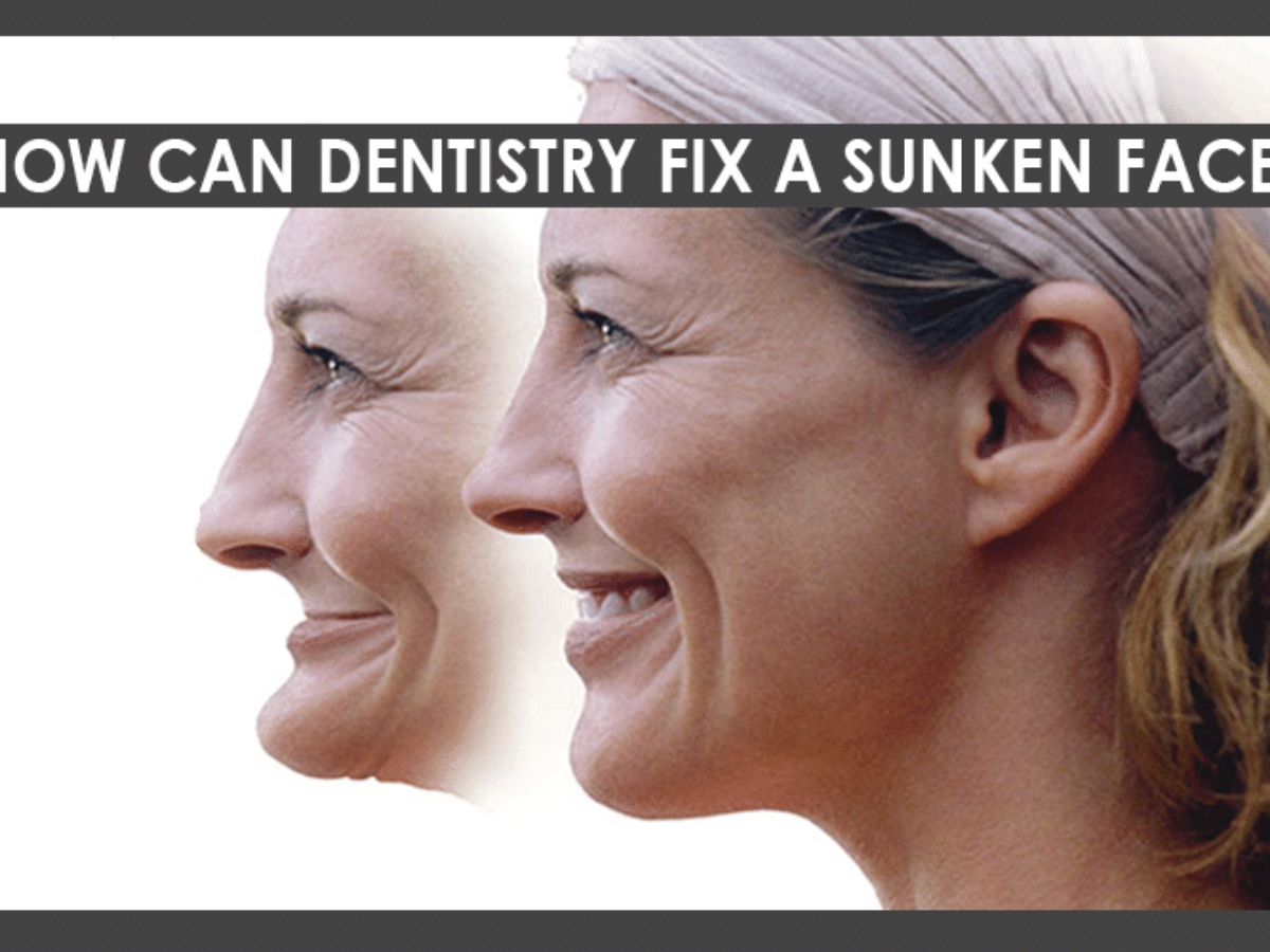 Sunken Face How Multiple Missing Teeth Affect Your Face