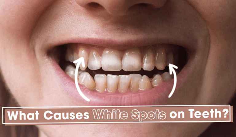 what-do-white-spots-on-your-teeth-mean-how-to-get-rid-of-them