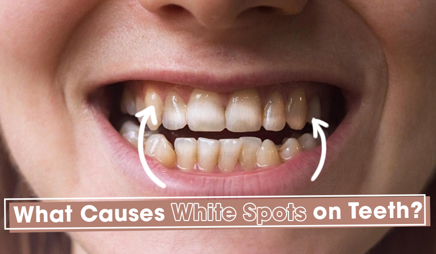 What Do White Spots On Your Teeth Mean How To Get Rid Of Them