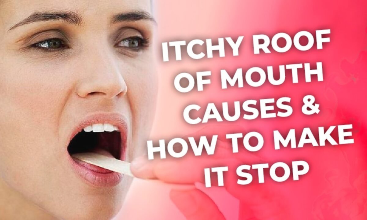 Itchy Roof Of Mouth Causes How To Make It Stop