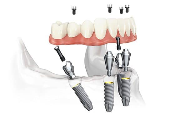 all on 4 dental implants in mexico