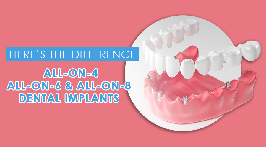 All-on-4, All-on-6, & All-on-8 Dental Implants: Here’s the Difference