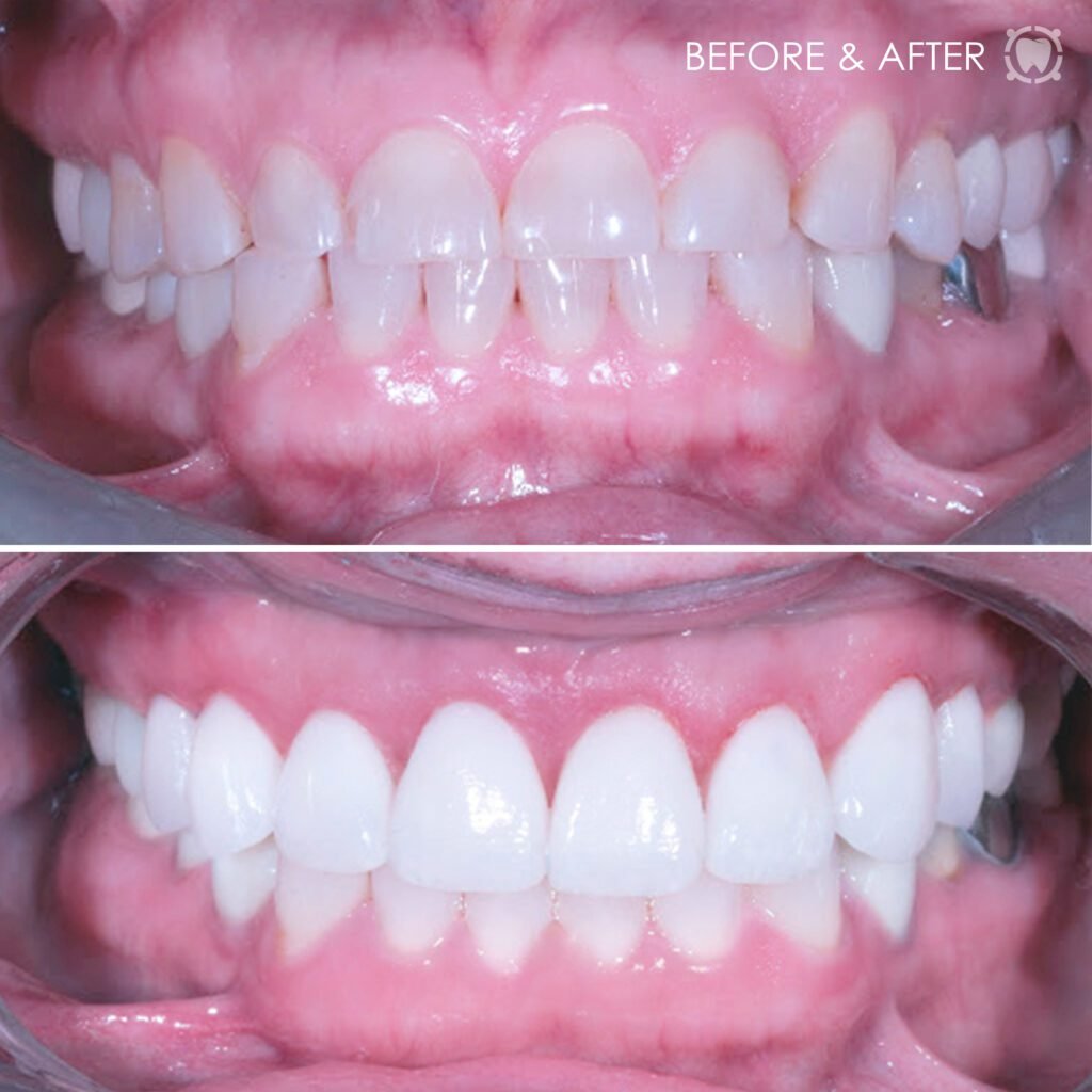 Teresa's smile makeover before and after pictures