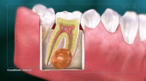 What Is a Gingival Cyst? Causes & Symptoms – Trust Dental Care