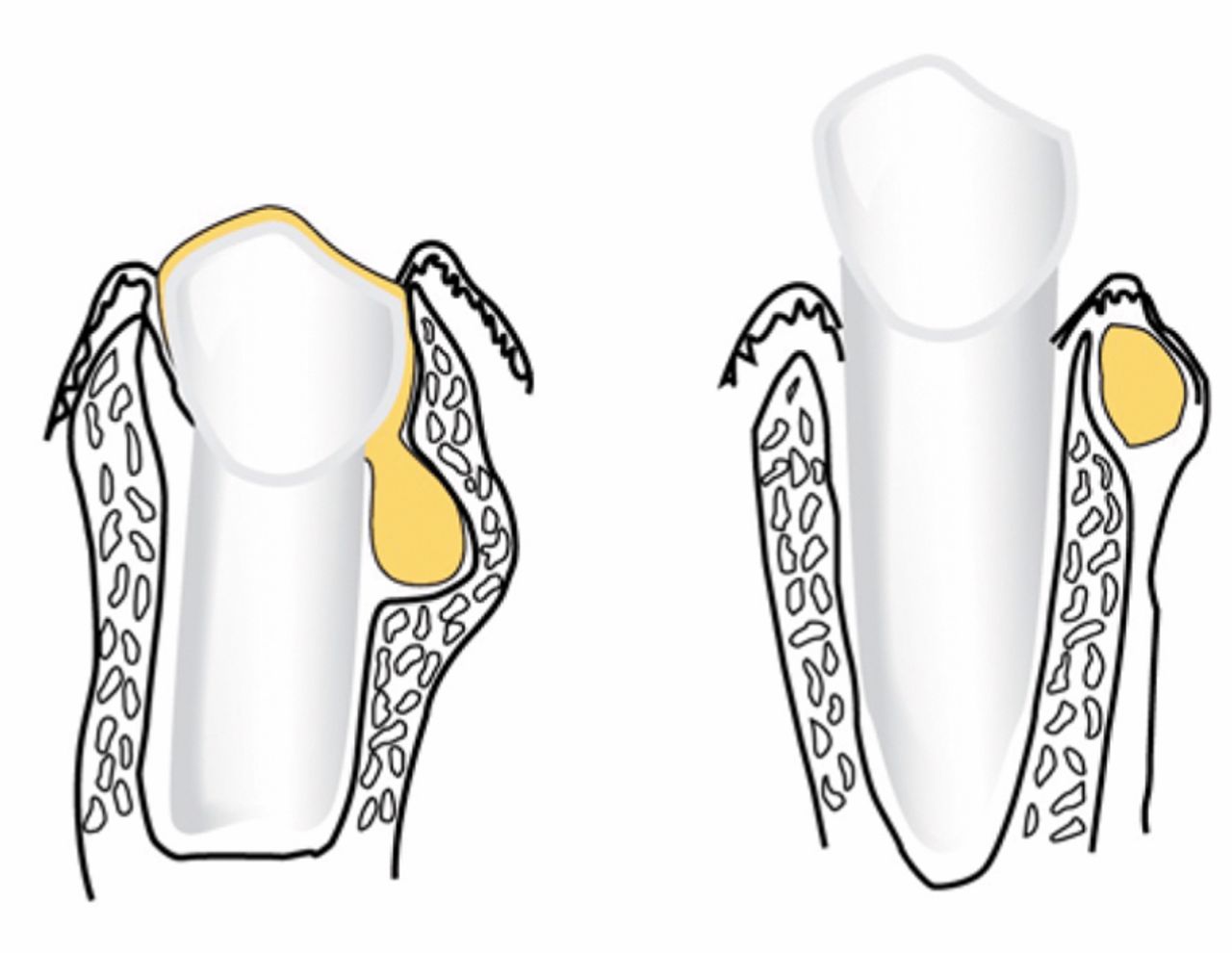 gingival-cyst-causes-symptoms-treatment