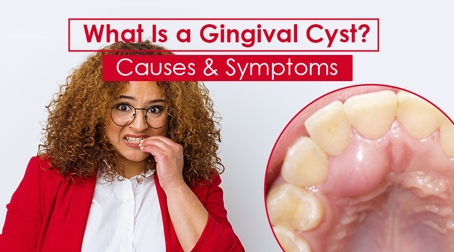 gingival cyst