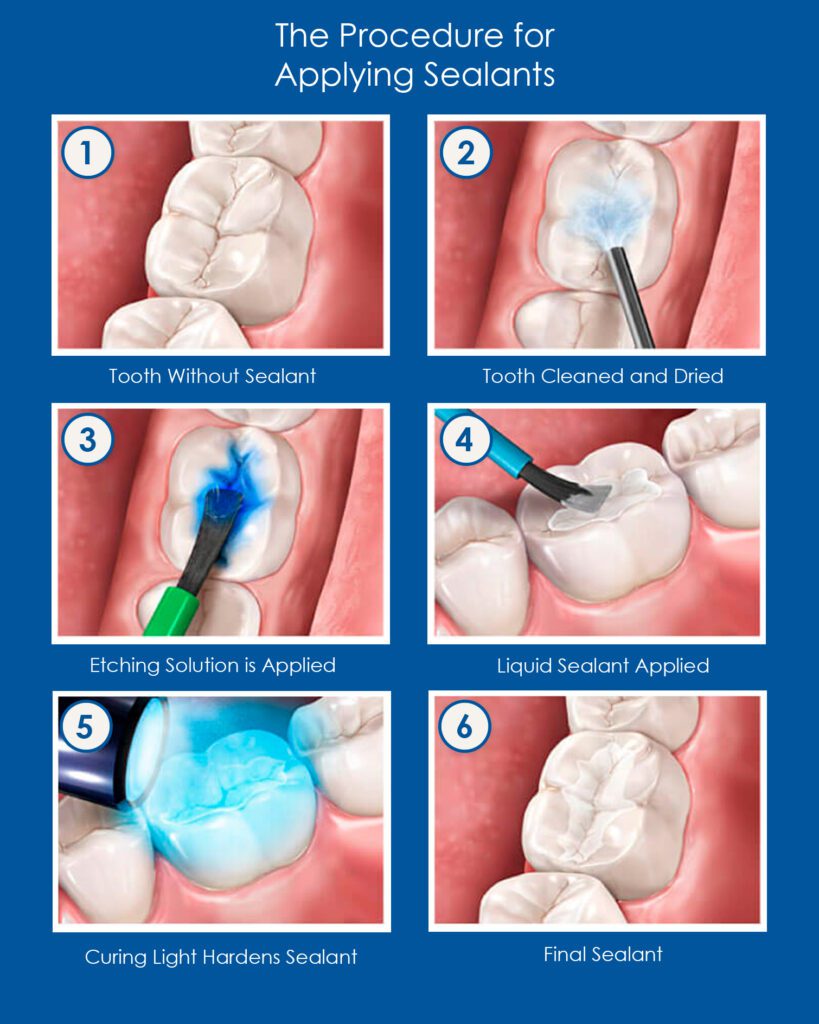 What Is The Procedure for Applying Sealants?