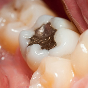 Is Dental Amalgam Safe?