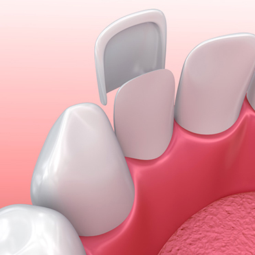 What is a Dental Veneer?