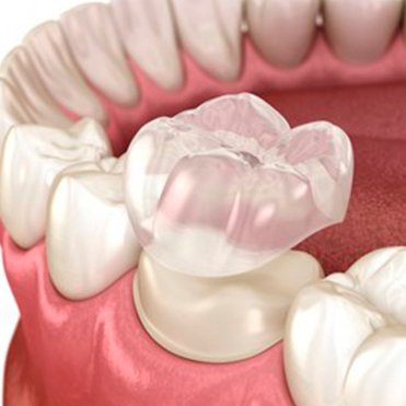 Dental crown preparation: