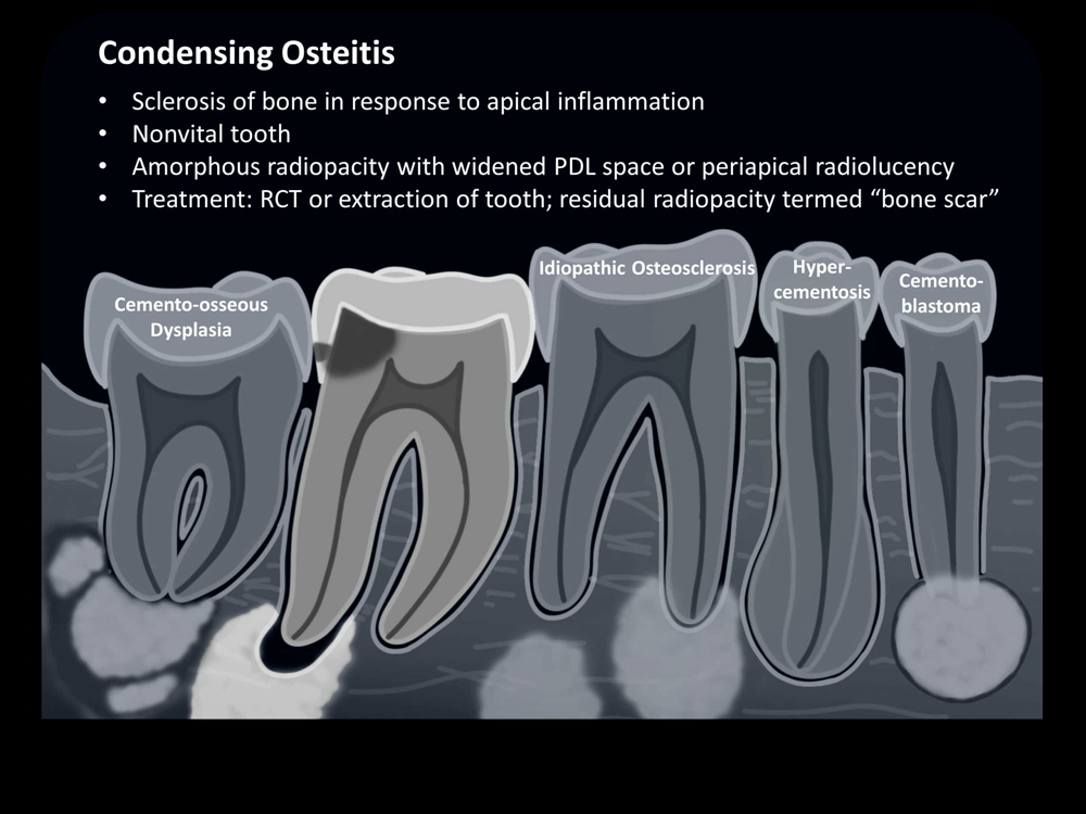 What is Condensing Osteitis?