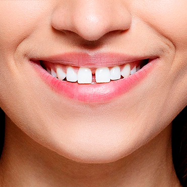 A mouth with diastema (a gap between the front incisors).