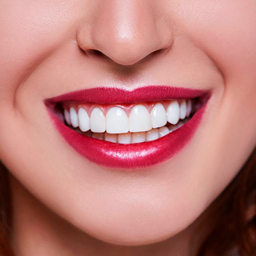 A close-up image of a woman smiling showing dental veneers.