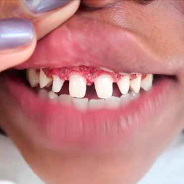 A closeup of a mouth with the upper front six teeth shaven for dental veneers.