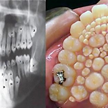 What Are The Causes of Hyperdontia?