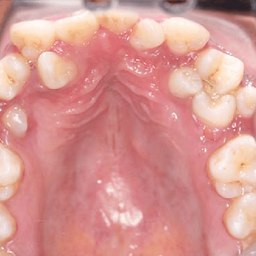 What If You Don't Treat Hyperdontia?