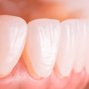 How Veneers Will Make Your 2022 So Much Better