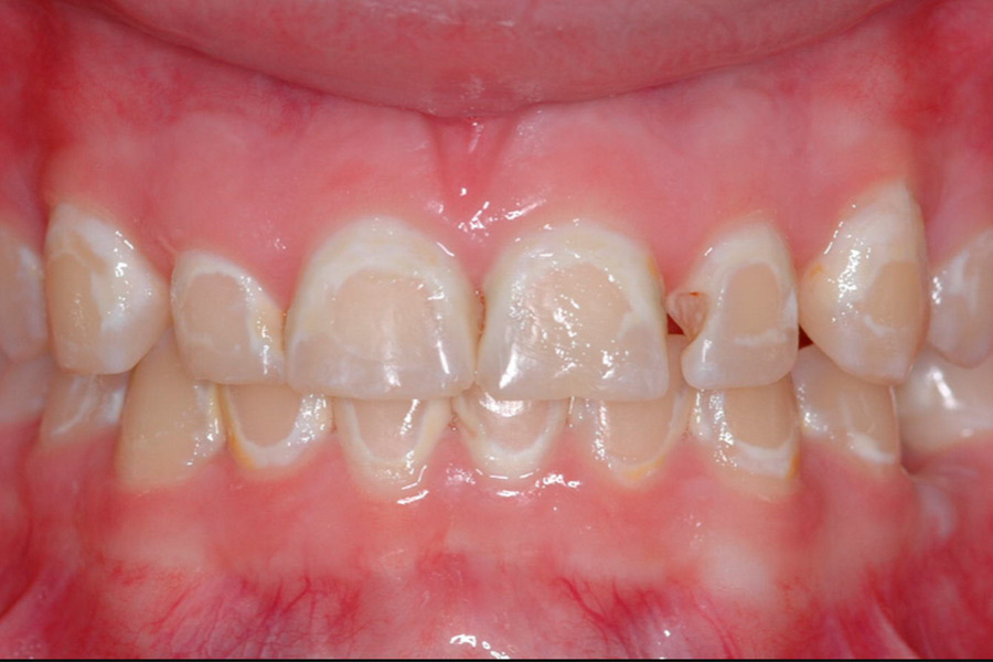 What Are the Signs of Enamel Hypoplasia?