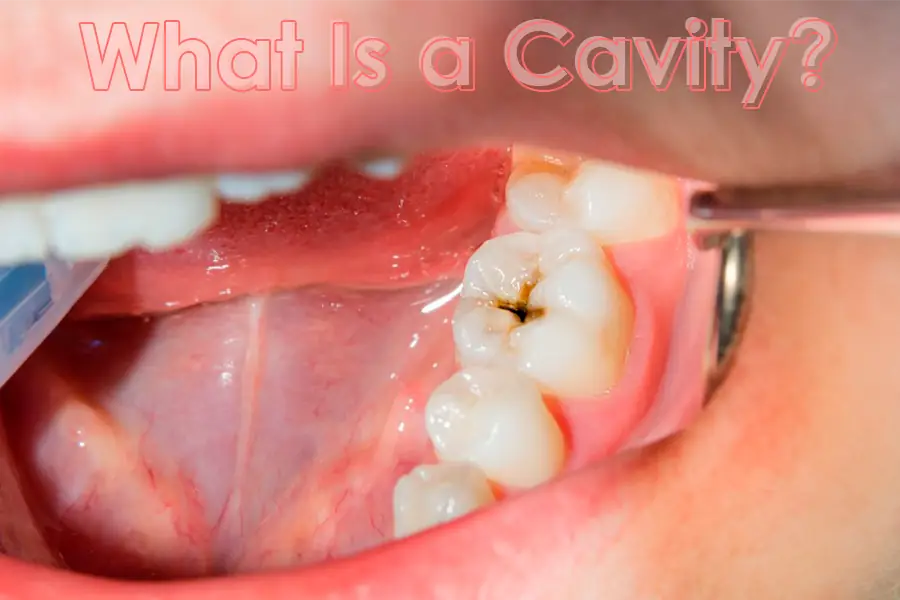 What is tooth stain vs cavity
