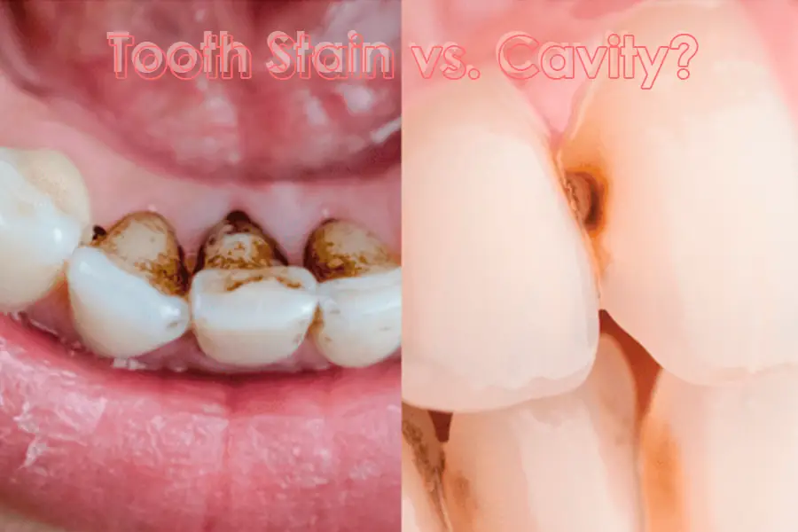 Differences Between a Tooth Stain vs Cavity