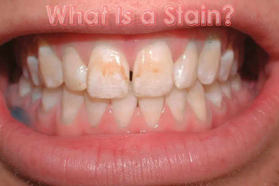 What is a Stain Trust Dental Care