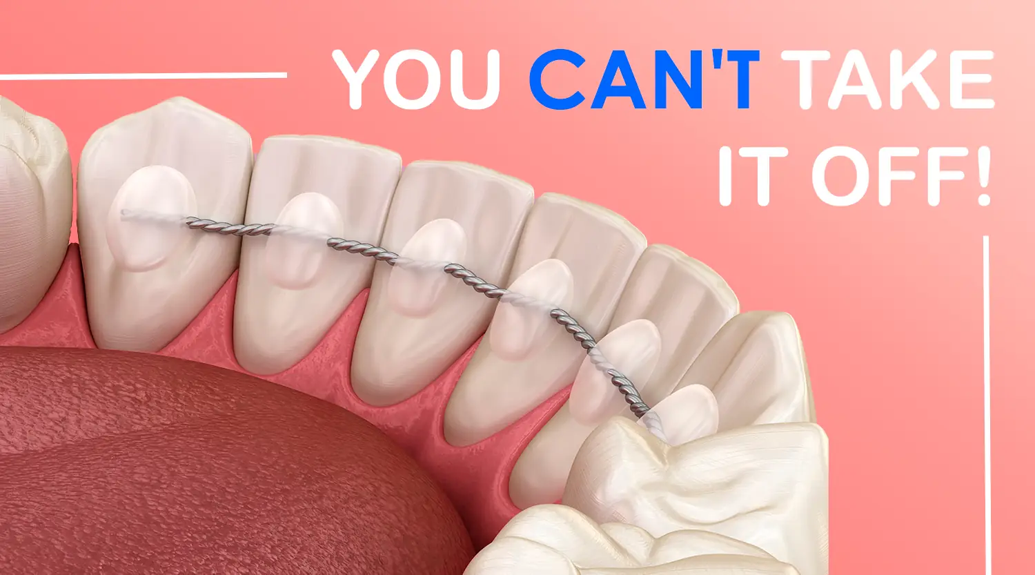 Are Permanent Retainers Worth It? Experts Weigh In