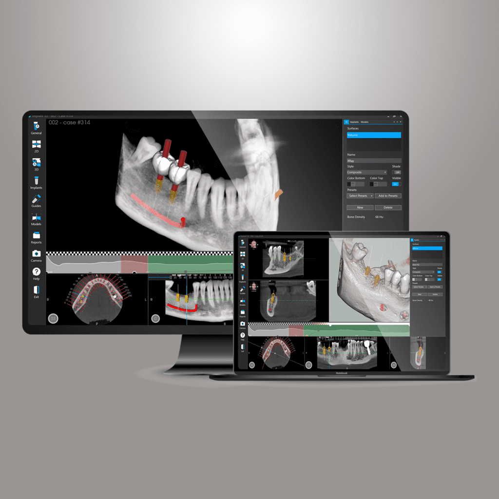 An image representing AI 3D implant planning software and surgical guides for precise dental implant procedures.