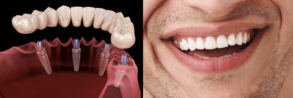 An illustration depicting the All-on-4 dental implant procedure and a perfect smile.