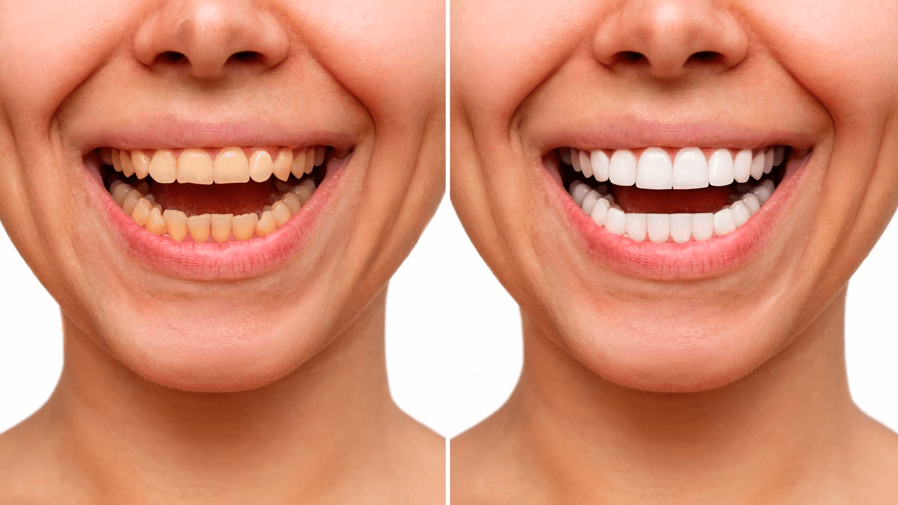 A comparison of teeth before and after a whitening treatment.