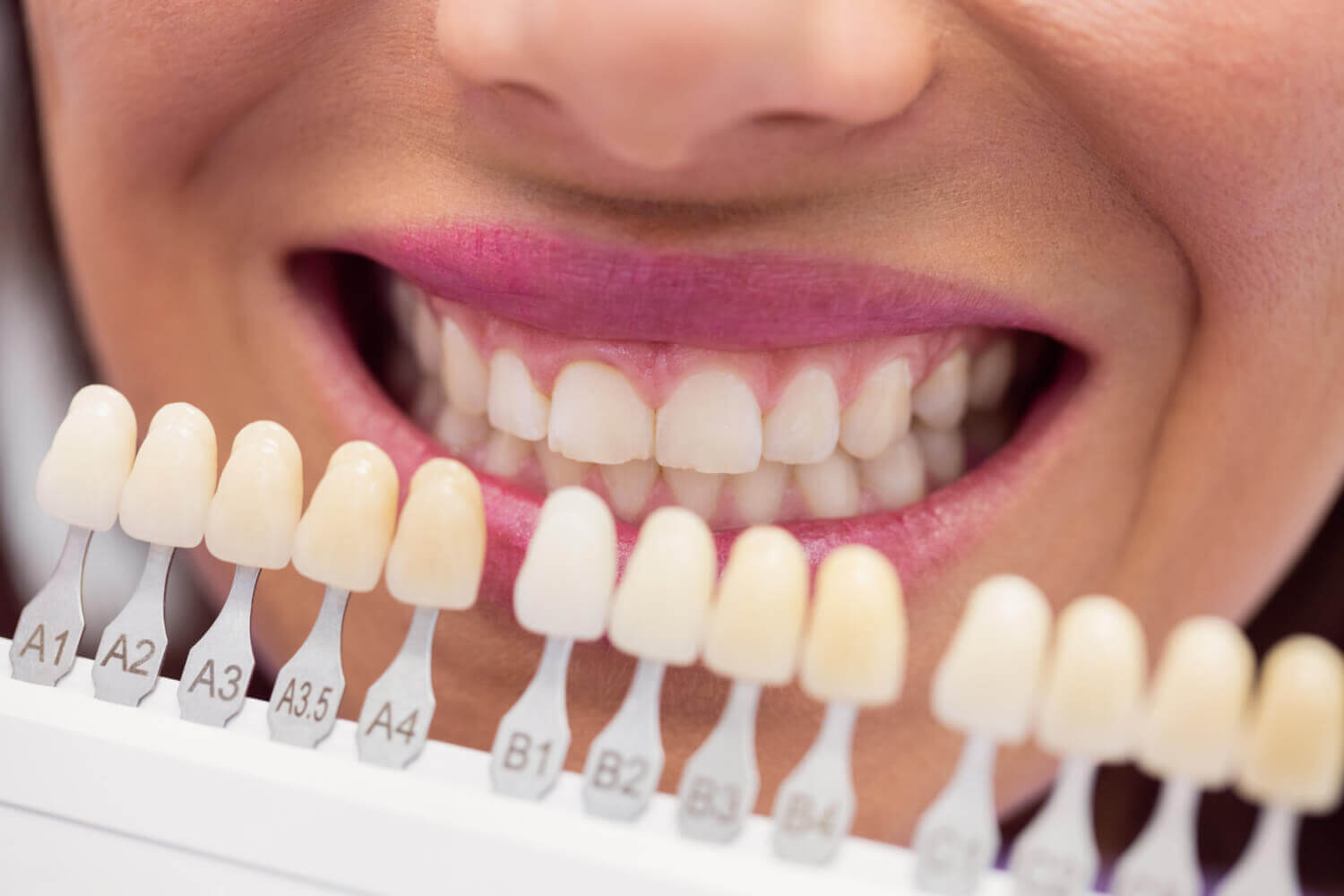 A dentist using a shade guide to select the perfect tooth color for a dental procedure.