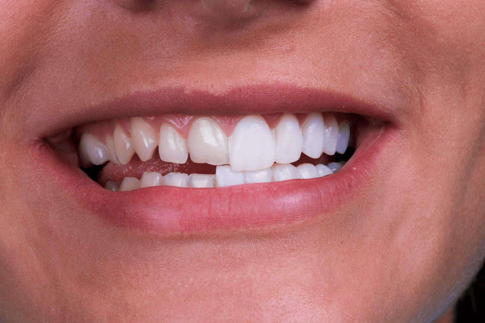A comparison photo of a smile with veneers applied to one side and natural teeth on the other, highlighting the difference.