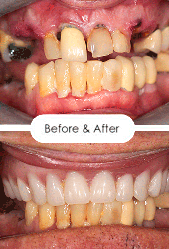 A side-by-side comparison showcasing a smile before and after the All-on-4 treatment, revealing a flawless and perfect transformation.