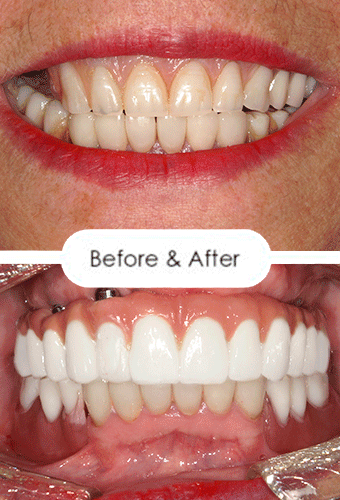 A captivating visual journey depicting a smile before and after All-on-4 treatment, showcasing a complete and radiant transformation