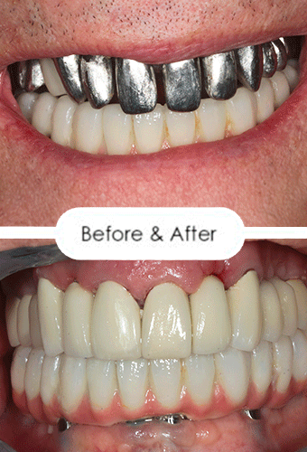 A transformative image showcasing a smile transitioning from metal dental crowns to perfection through the All-on-4 treatment.