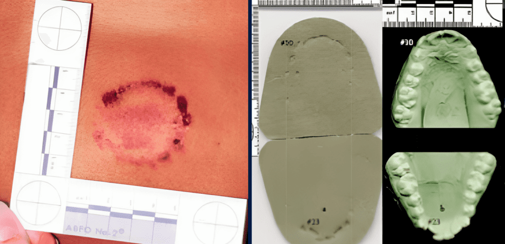 A clear bite mark on the skin, a 3D rendering of a bite, and a marked impression for bite mark analysis.