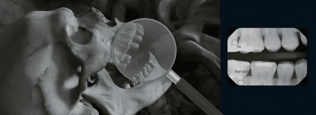 An X-ray image of dental records used in forensic dentistry.