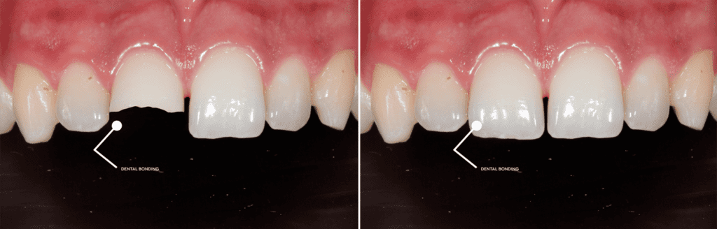 Same day dentistry Comparison of teeth before and after dental bonding procedure.