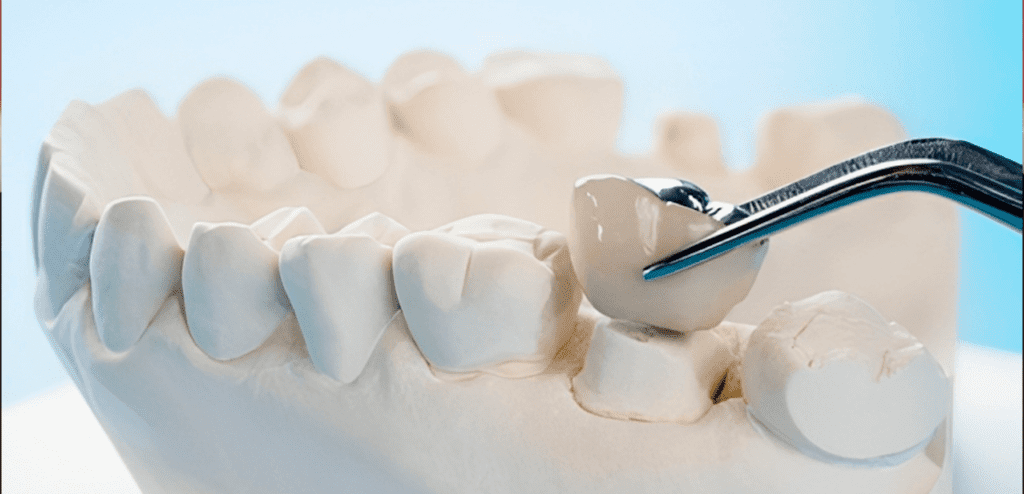 Comparison between traditional dental crowns and same-day dental crowns