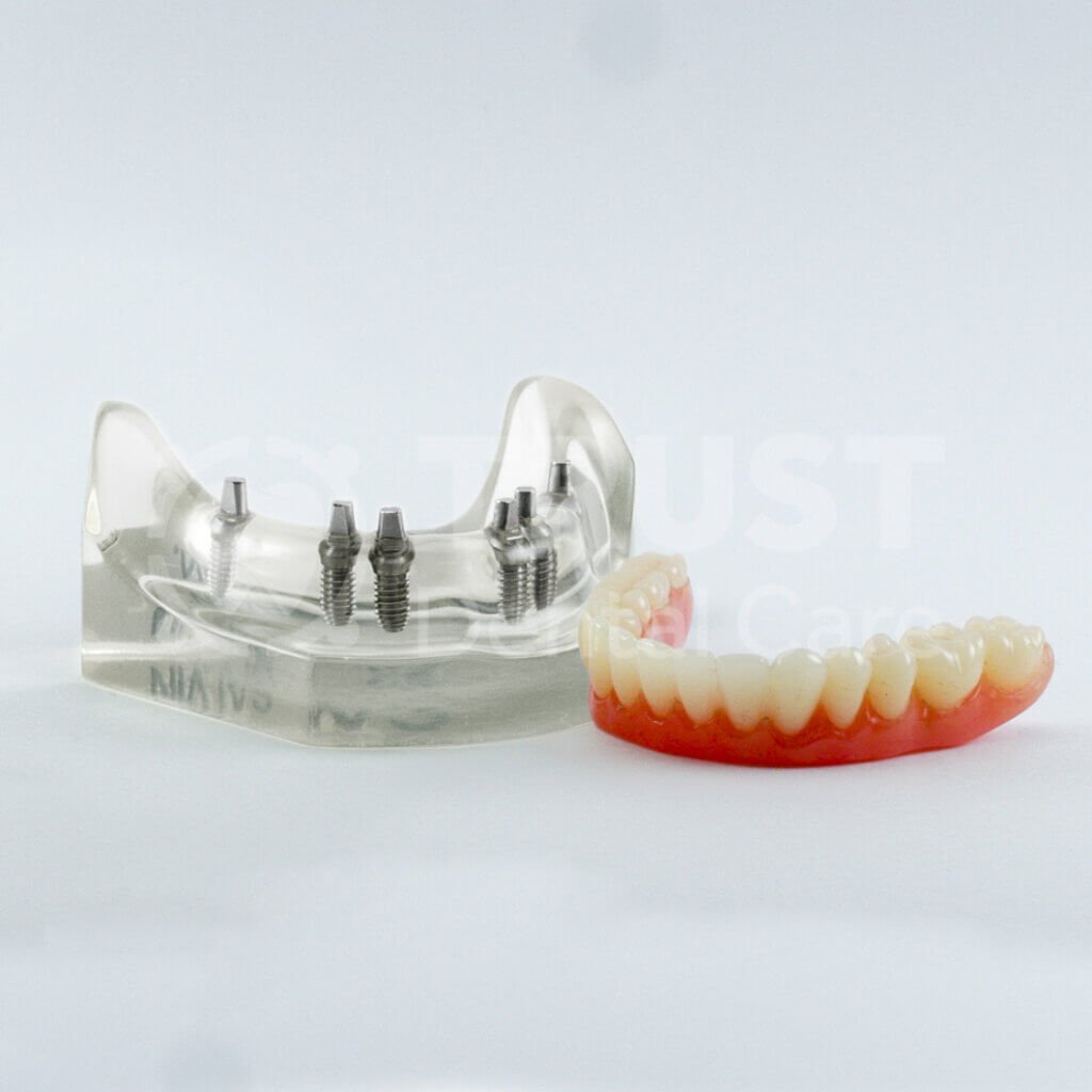 All-On-6 Dental Implants 2