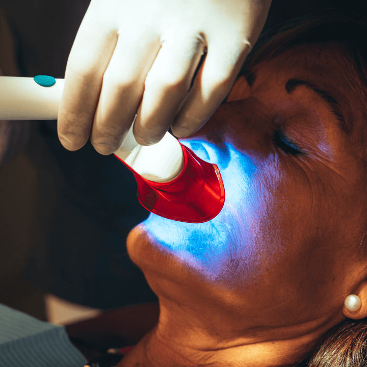 Laser Teeth Cleaning 2